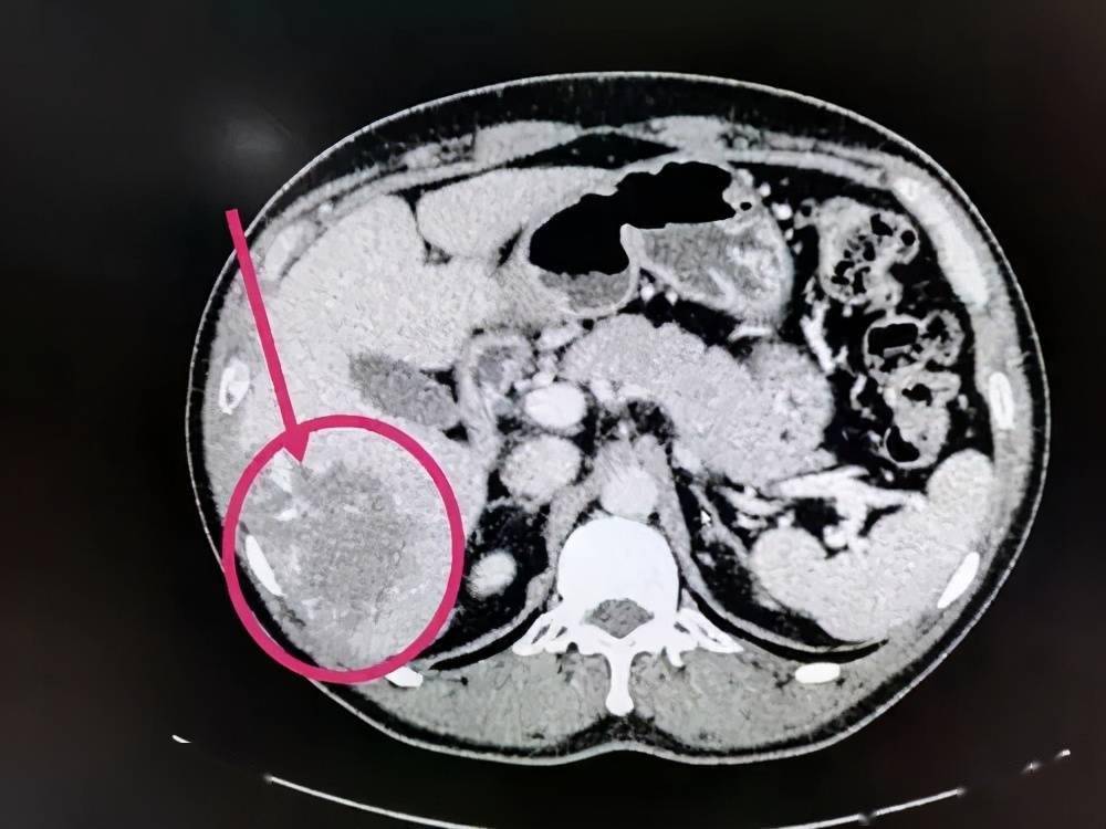 04肉芽肿肉芽肿分为全身性以及局部发作性,如果是全身性的肉芽肿通常