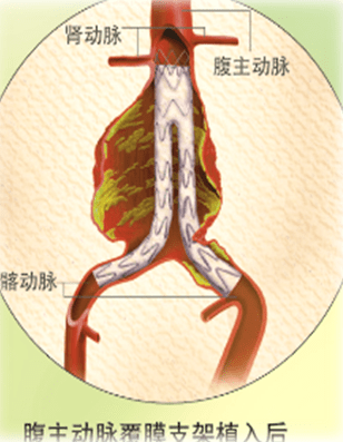 腹主动脉瘤支架图片