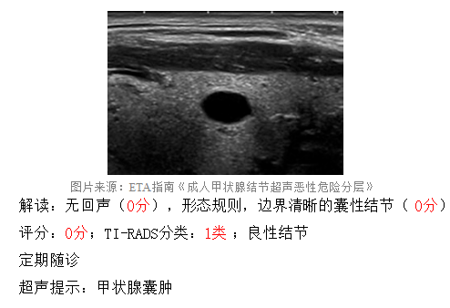 甲状腺结节超声判读5部曲从哪看起如何判读良恶性