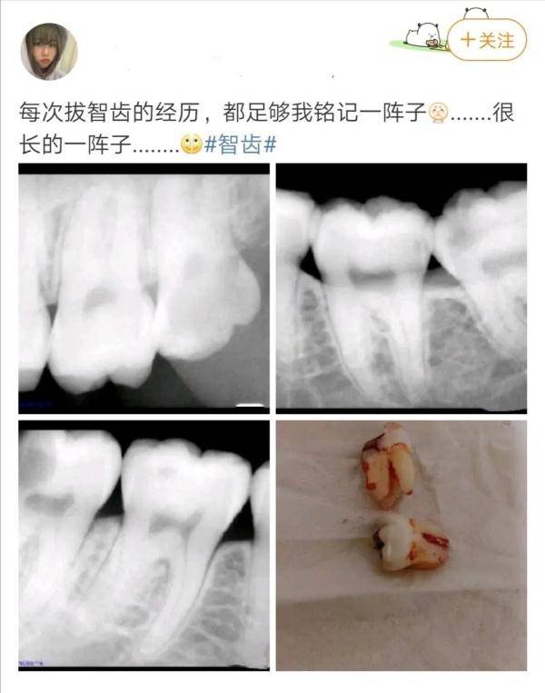 大学生抜智齿是一种什么感觉?