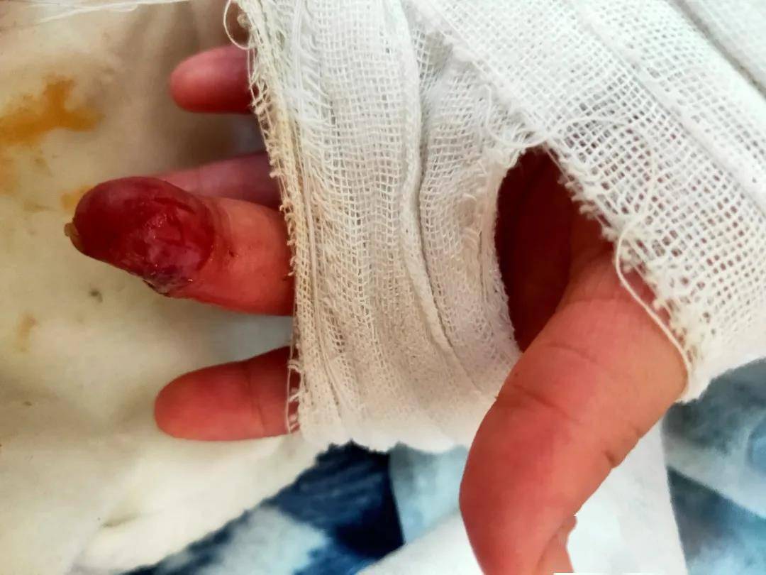 术后珊珊的手指供血情况良好,受伤的手指已经逐渐恢复血色