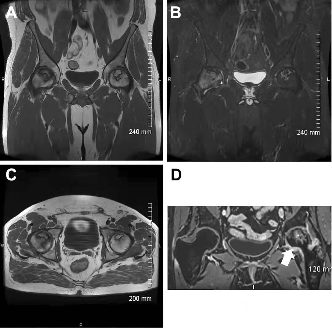 股骨头坏死mri表现图片