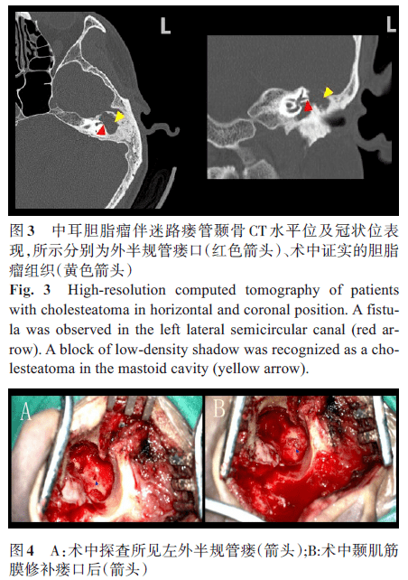 中耳膽脂瘤併發迷路瘻管的臨床特徵