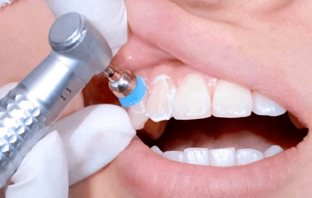 武汉丨41店适用仅399元享门市价235元67大众口腔基础洁牙套餐超声波