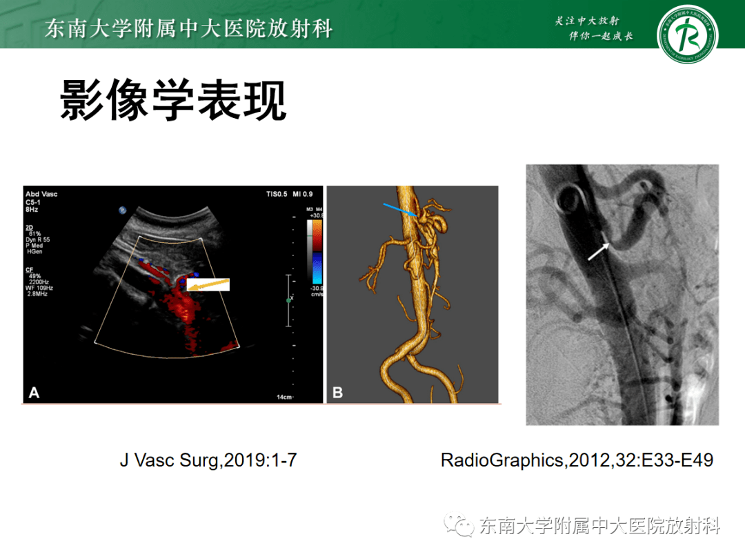 正中弓状韧带压迫综合征mals