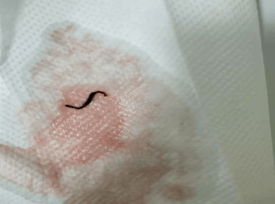 后怕注射器回抽见1cm血栓深静脉置管应有效维护