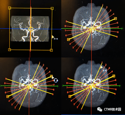 手把手基础教程颅脑3dtofmra扫描及后处理