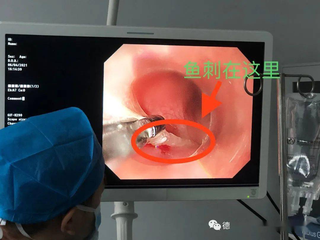 医人医事76|这条"鱼"吃的有点贵……_鱼刺