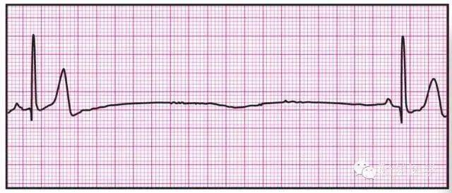 诊断学异常心电图图片