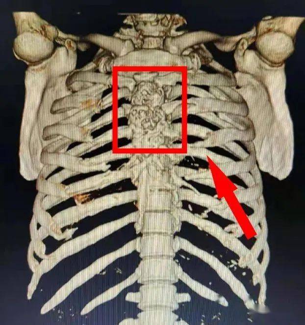 胸骨的位置图片真人图片