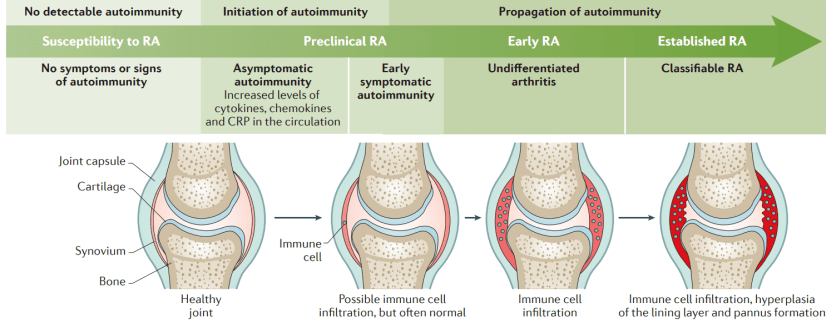 田新平教授改善类风湿关节炎患者远期预后早期规范治疗是关键