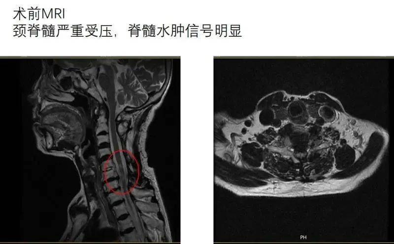 淄博市中心醫院脊柱外科成功為一名79歲高齡複發性脊髓型頸椎病患者