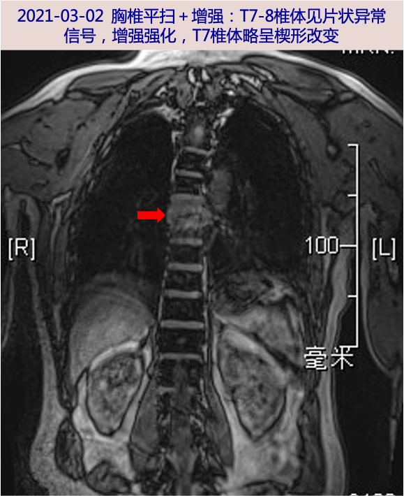 t2wi壓脂為稍高信號,增強呈較明顯強化,t7椎體略呈楔形改變:t7-8椎體