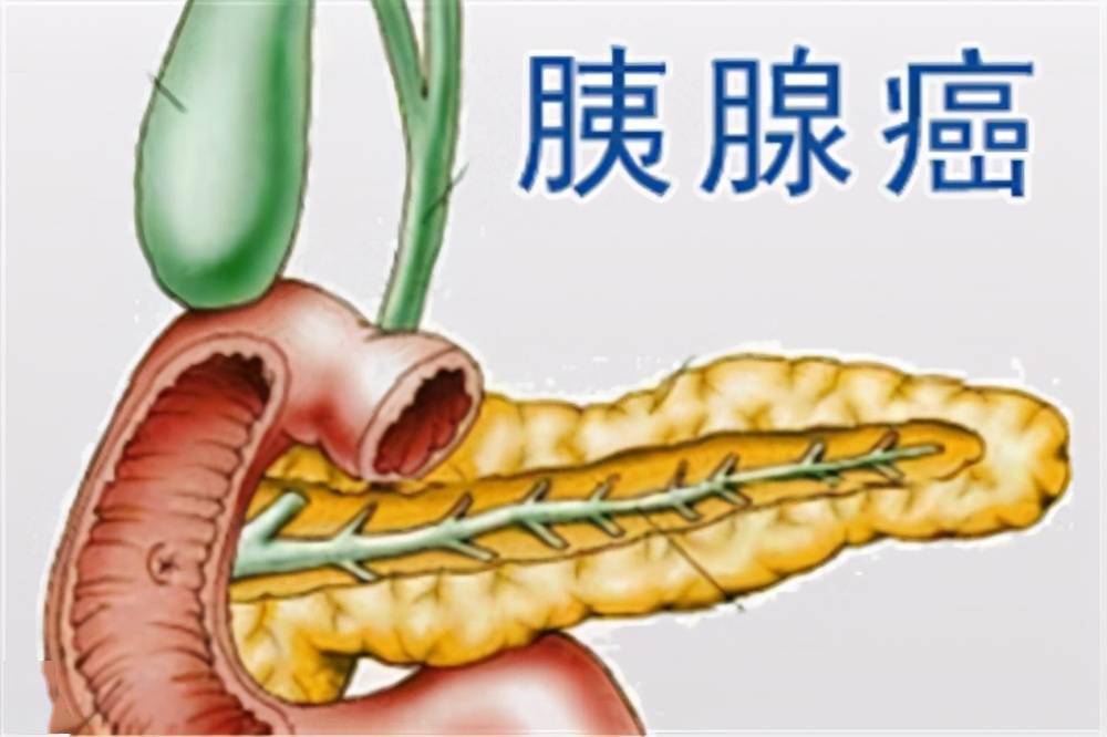 血糖飆升究竟是糖尿病還是胰腺癌二者有何聯繫