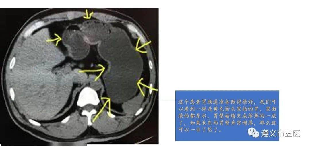 科普||腹部ct检查为什么要多喝水?