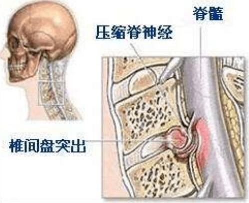 我院开展首例颈椎间盘突出症前路手术 治疗