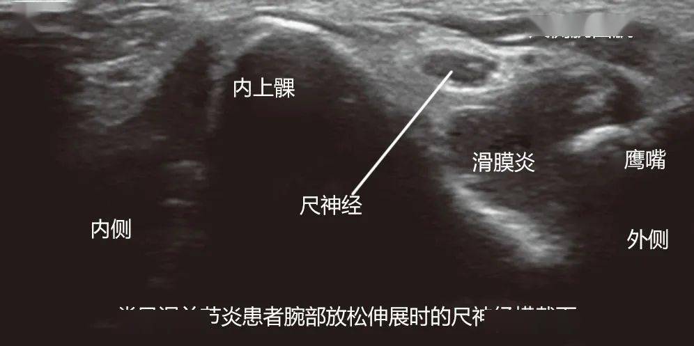 疼痛解剖学 肱三头肌弹响综合征 弹响征 神经