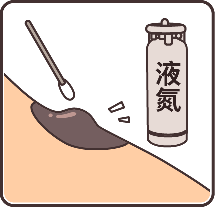痣也可能会癌变!长在 3 个地方要注意