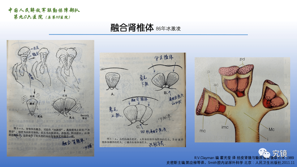 实战穿刺增加了难度那么我们从超声上如何分辨呢肾椎体融合的程度不同