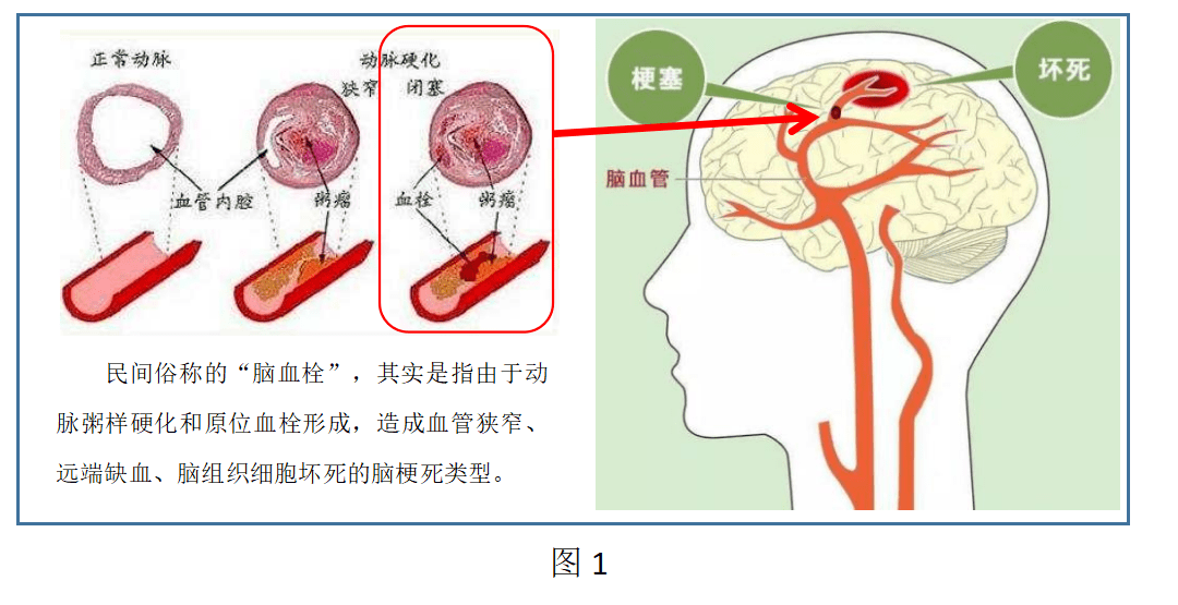 科普丨脑卒中脑中风脑梗死脑梗塞脑血栓脑栓塞脑出血脑溢血傻傻分不