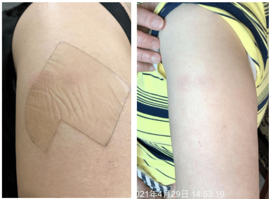 接种疫苗后都说痛是并发症还是不良反应