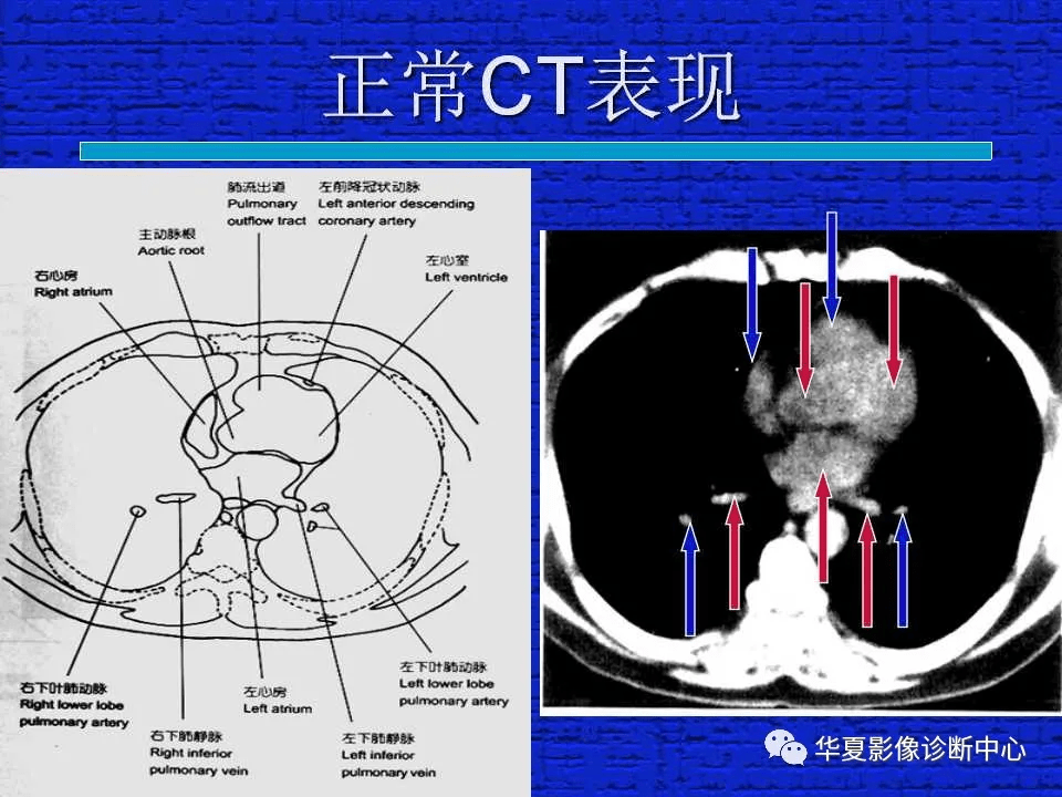 肺部正常ct阅片入门图片