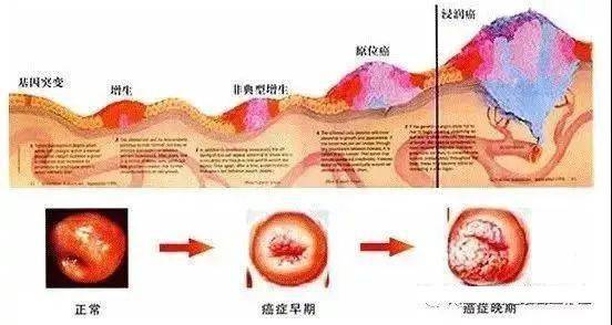 宫颈癌是女性生殖系统