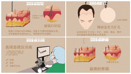 拒绝容貌焦虑3d植发为你带来立竿见影的美丽