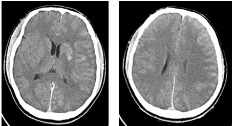 複查ct可見左側大腦半球明顯水腫,出現中線移位.