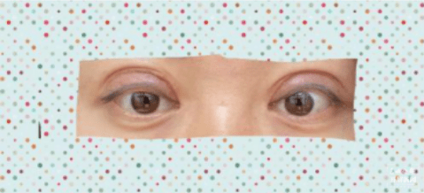 怎样快速去眼皮肿 6b03914efd15415598372631e40bfd7f.png