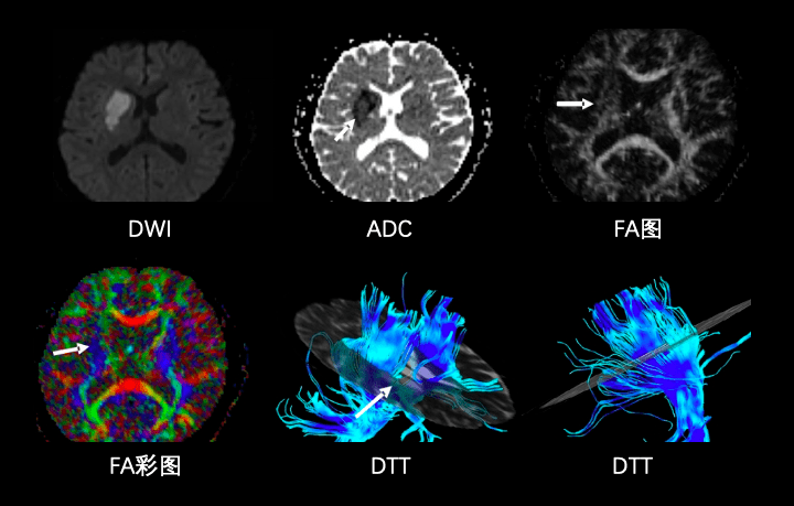 磁共振功能成像dti2