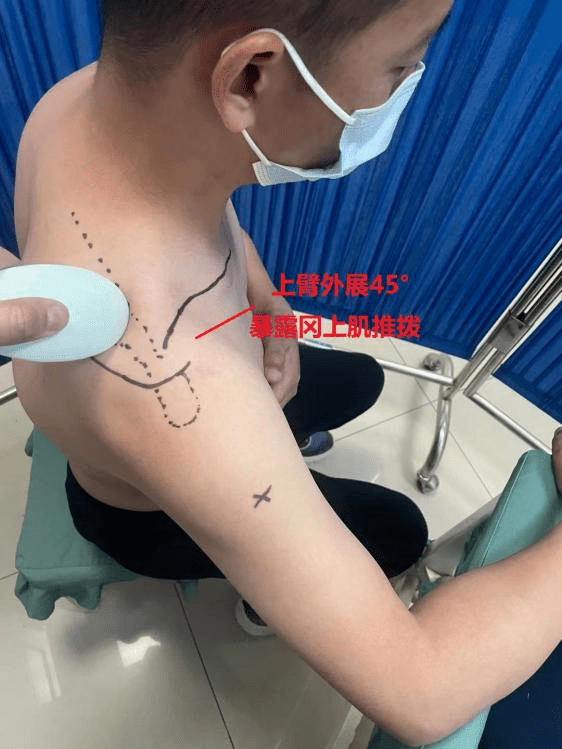 棍针治疗系列冈上肌的治疗