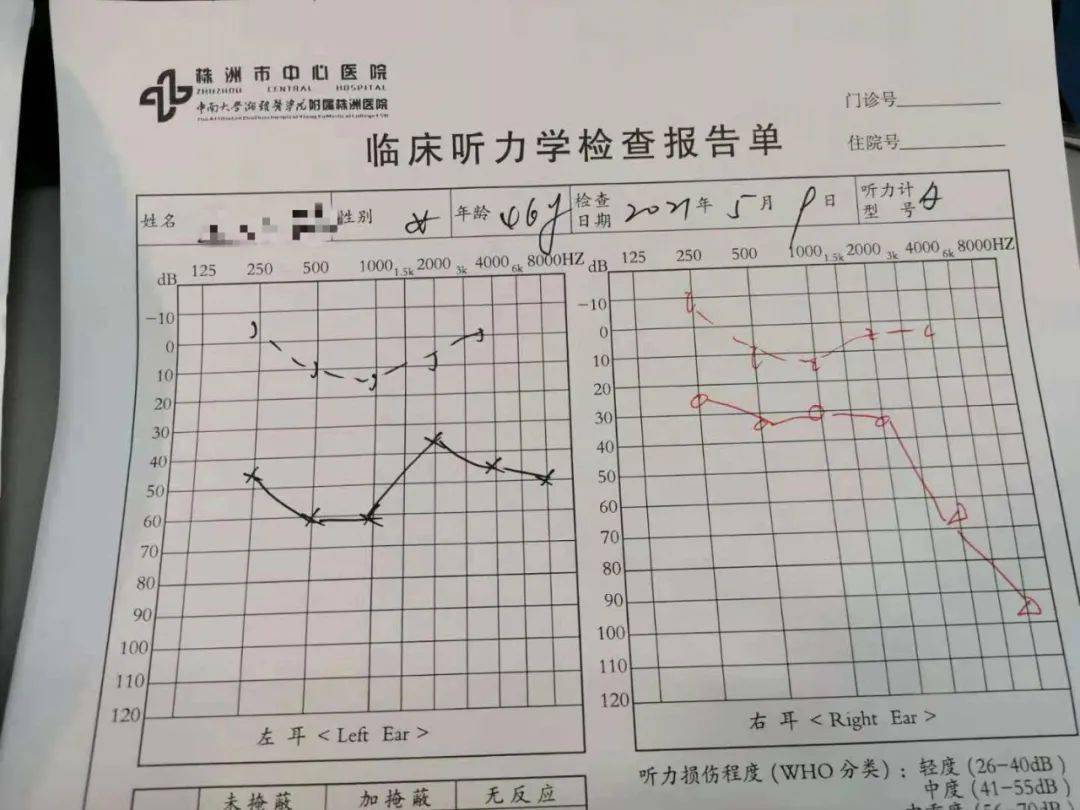 耳硬化症纯音测听图图片