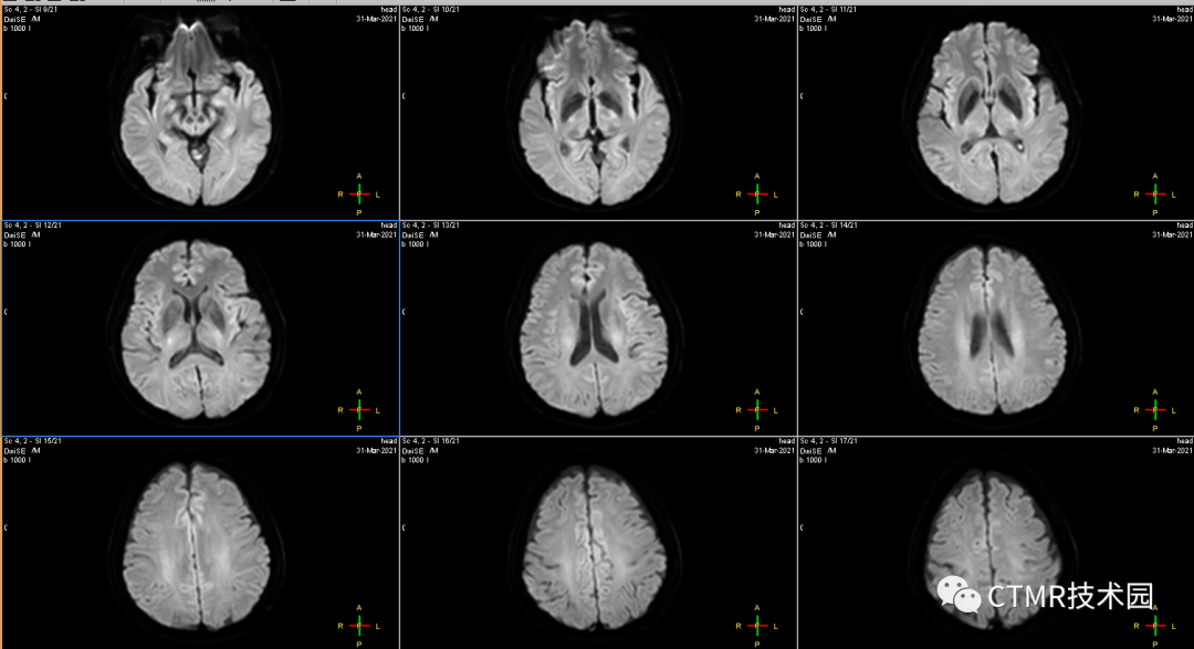手把手教你基础颅脑mr平扫及后处理