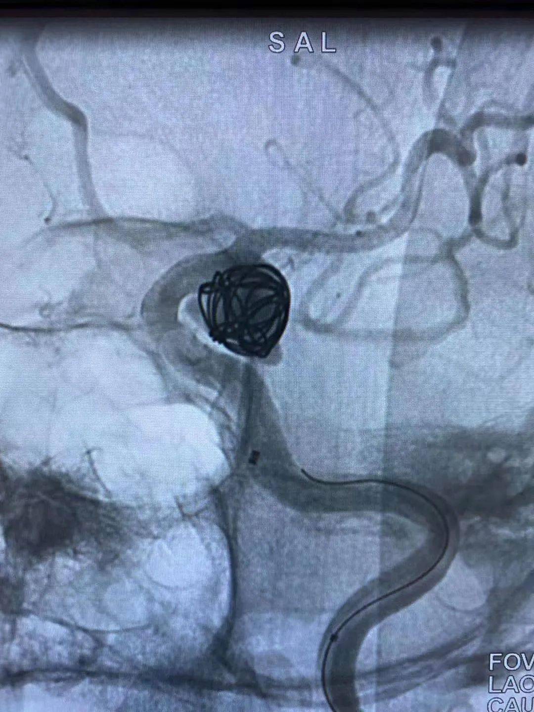 闯五关为患者拆除脑内炸弹神经外科成功开展大动脉瘤密网支架置入术新