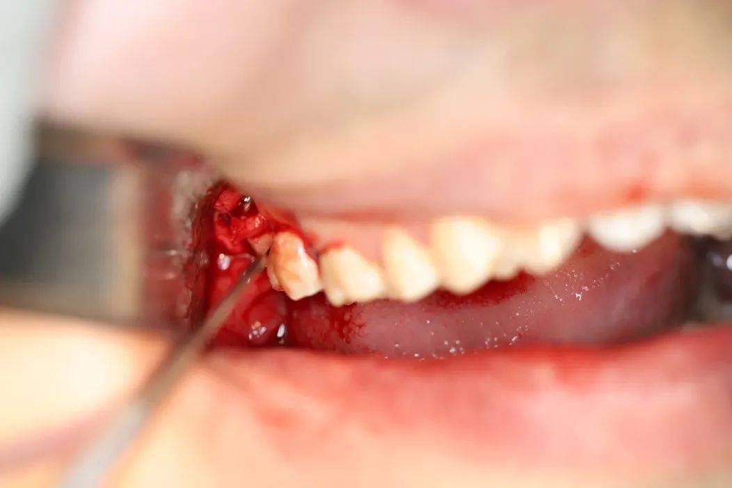 阻生齿拔牙过程图片
