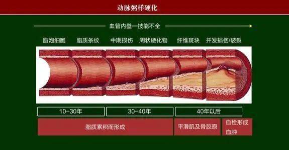 动脉硬化形成的原因图片