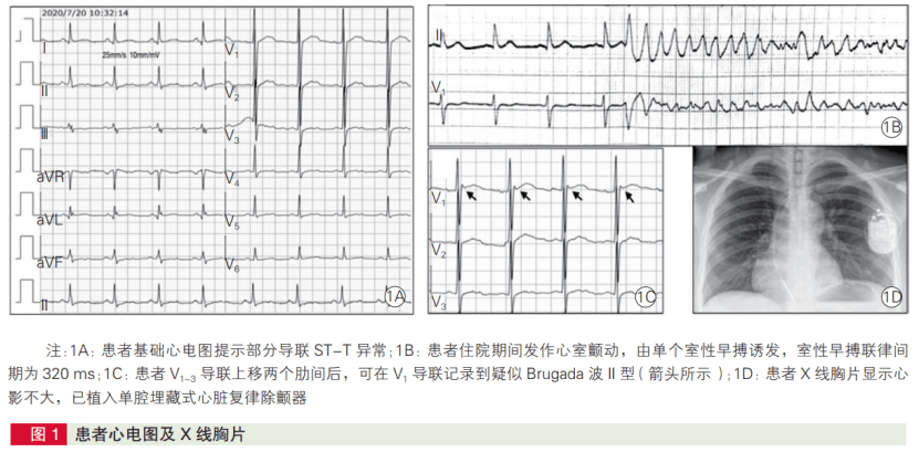 发热 还能诱发室颤 阜外华中医院疑难病例 患者