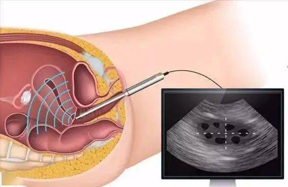 为什么要做阴道超声检查痛不痛