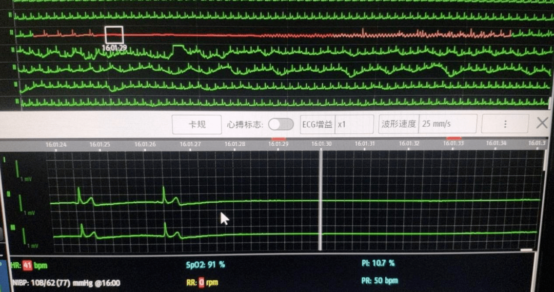 打麻将心脏停跳48秒