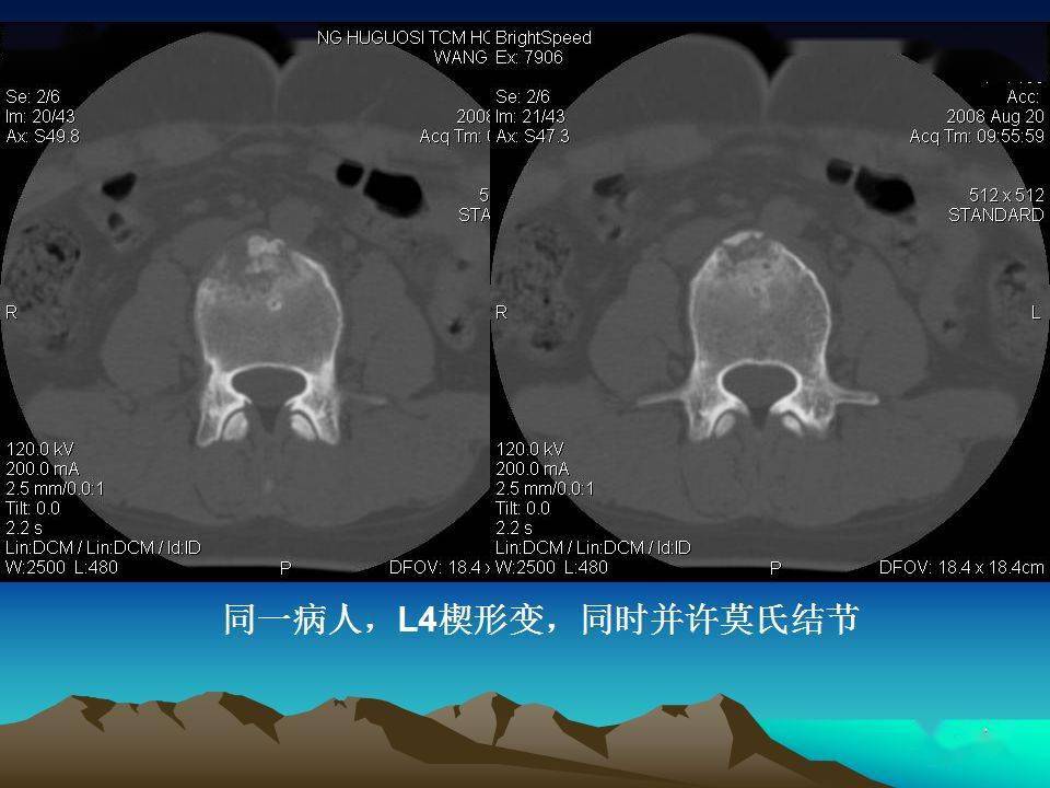 腰椎ct扫描层面及常见疾病的诊断(附真实病例)