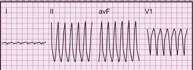14種常見心電圖波形的特點,建議收藏!