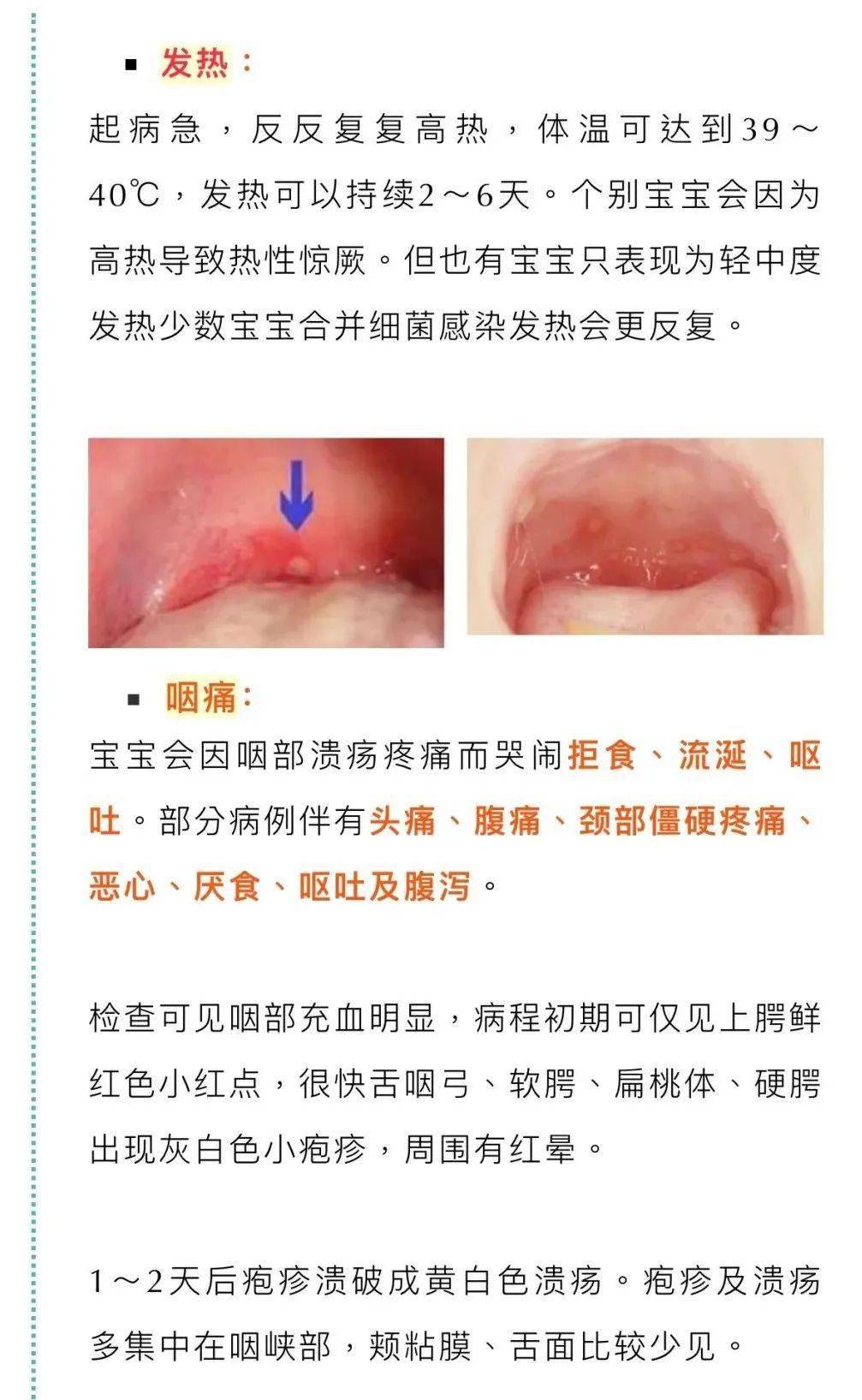 咽峡炎传染吗图片