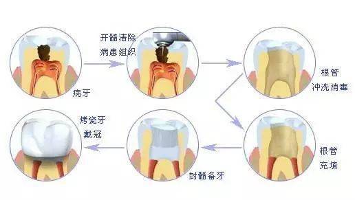 根管治疗不做冠牙齿迟早留后患