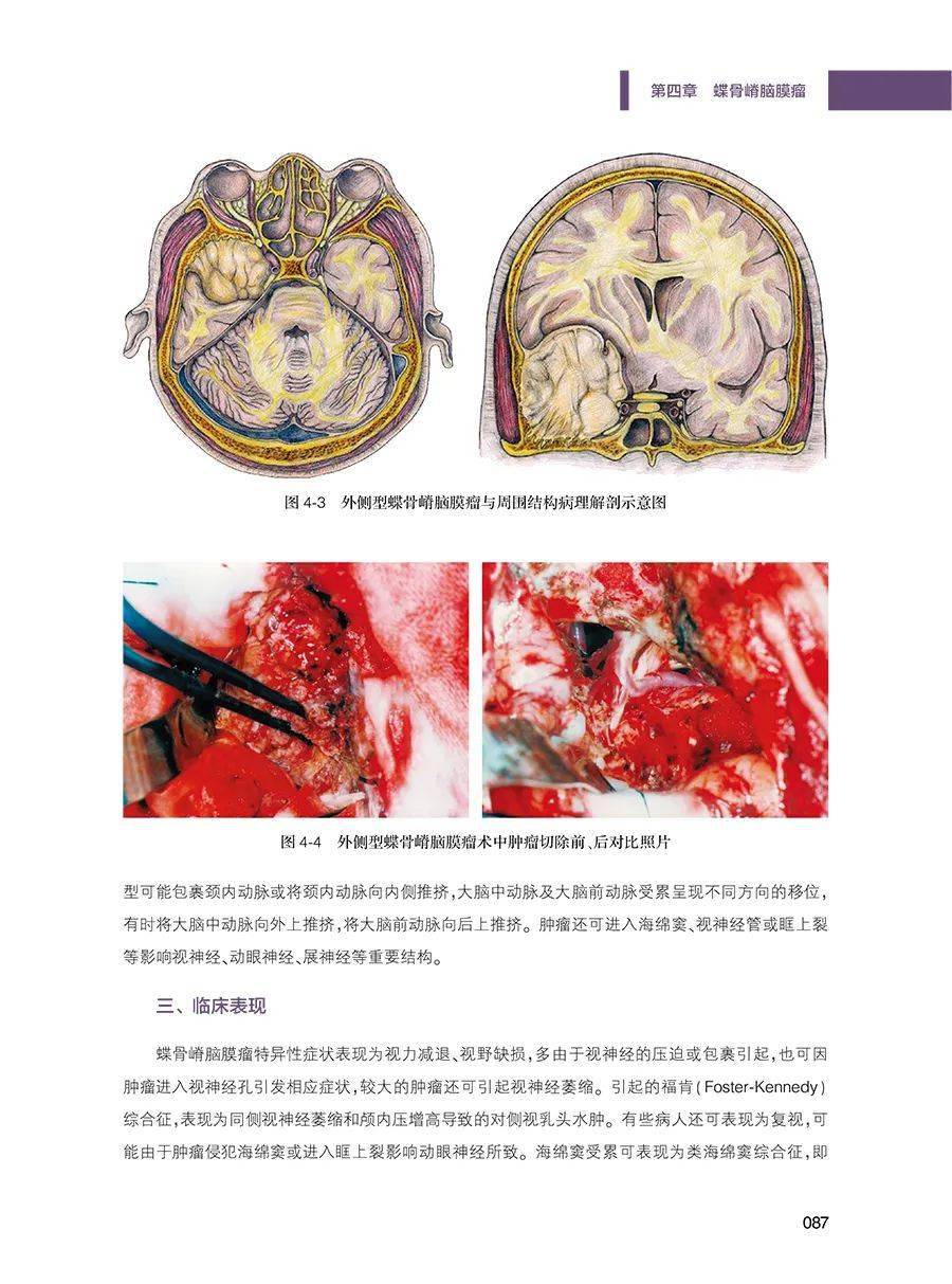 【新書推介】顱底腦膜瘤外科手術精粹,張俊廷教授主編_視頻