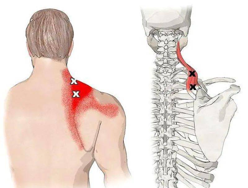 肩部筋膜炎,也可以称为肩部肌肉劳损