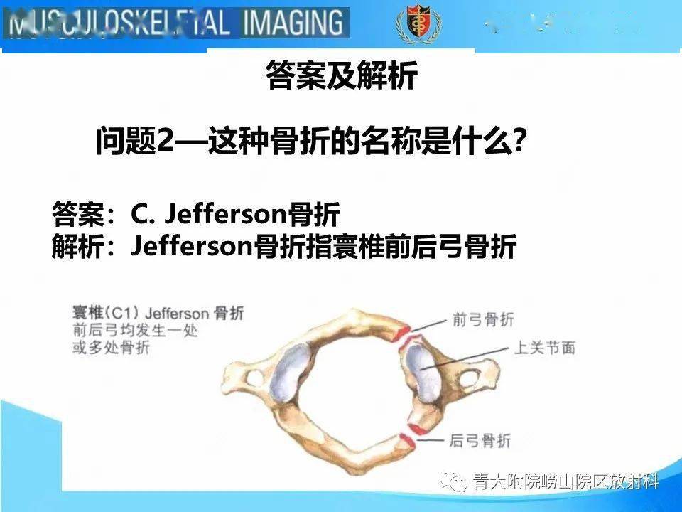 jefferson骨折_放射科