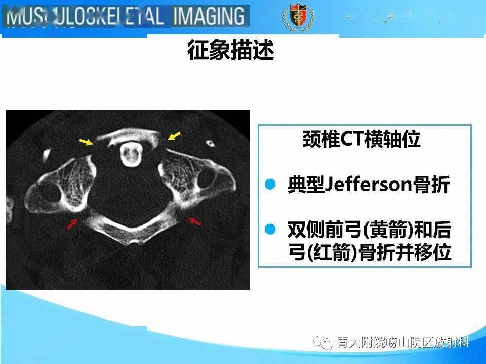 jefferson骨折_放射科
