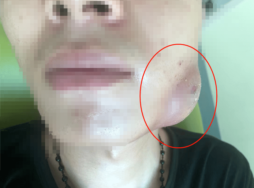 如果智齿发炎感染,症状会比较棘手,难以用药,也没有办法进行拔牙处理