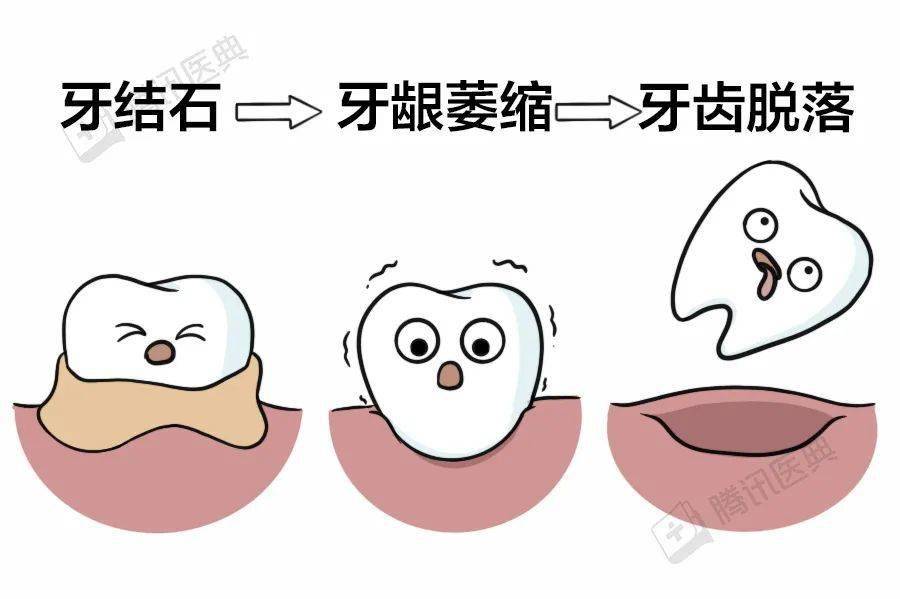 牙齿松动了补钙有用吗